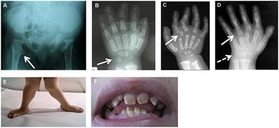 Chondrodysplasias With Multiple Dislocations Caused by Defects in Glycosaminoglycan Synthesis